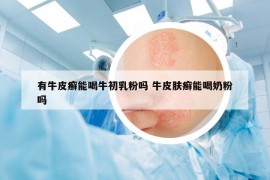 有牛皮癬能喝牛初乳粉嗎 牛皮膚癬能喝奶粉嗎
