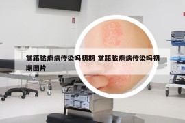 掌跖膿皰病傳染嗎初期 掌跖膿皰病傳染嗎初期圖片
