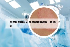 牛皮屑初期圖片 牛皮屑初期癥狀一般吃什么藥