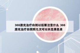 308激光治療白斑以后要注意什么 308激光治療白斑照幾次可以長出黑色素
