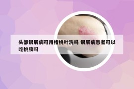 頭部銀屑病可用楮桃葉洗嗎 銀屑病患者可以吃桃膠嗎