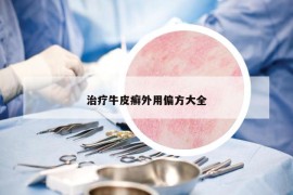 治療牛皮癬外用偏方大全