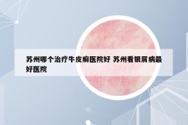 蘇州哪個治療牛皮癬醫(yī)院好 蘇州看銀屑病最好醫(yī)院