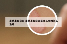 皮膚上有白斑 皮膚上有白斑是什么原因怎么治療