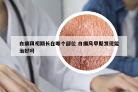白癩風(fēng)初期長在哪個(gè)部位 白癩風(fēng)早期發(fā)現(xiàn)能治好嗎