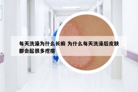 每天洗澡為什么長癬 為什么每天洗澡后皮膚都會(huì)起很多疙瘩