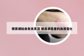 銀屑病給血有關(guān)系沒 銀屑病患者的血液變化