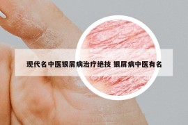 現(xiàn)代名中醫(yī)銀屑病治療絕技 銀屑病中醫(yī)有名
