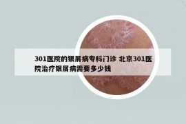 301醫(yī)院的銀屑病?？崎T診 北京301醫(yī)院治療銀屑病需要多少錢