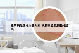 銀屑病是血液問題嗎那 銀屑病是血液的問題嗎