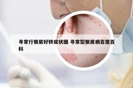 尋常行銀屑好轉(zhuǎn)癥狀圖 尋常型銀屑病百度百科