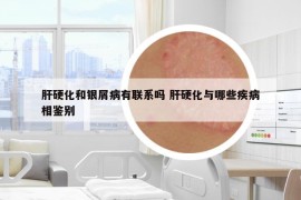肝硬化和銀屑病有聯(lián)系嗎 肝硬化與哪些疾病相鑒別