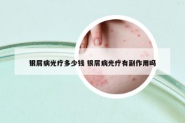 銀屑病光療多少錢 銀屑病光療有副作用嗎