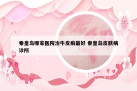 秦皇島哪家醫(yī)院治牛皮癬最好 秦皇島皮膚病診所