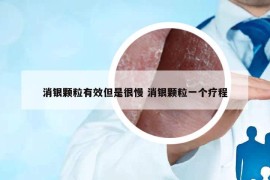 消銀顆粒有效但是很慢 消銀顆粒一個(gè)療程