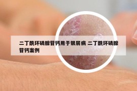 二丁酰環(huán)磷腺苷鈣用于銀屑病 二丁酰環(huán)磷腺苷鈣案例