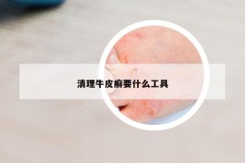 清理牛皮癬要什么工具
