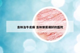 吉林治牛皮癬 吉林銀屑病好的醫(yī)院
