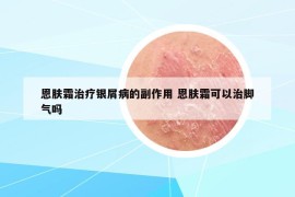 恩膚霜治療銀屑病的副作用 恩膚霜可以治腳氣嗎