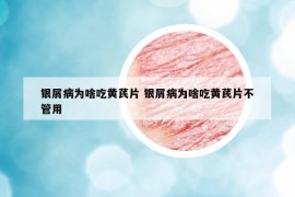 銀屑病為啥吃黃芪片 銀屑病為啥吃黃芪片不管用