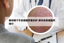 廊坊哪個(gè)牛皮癬醫(yī)院看的好 廊坊皮膚病醫(yī)院排行
