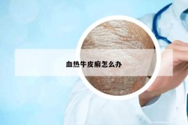 血熱牛皮癬怎么辦