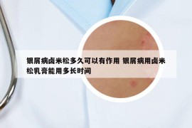 銀屑病鹵米松多久可以有作用 銀屑病用鹵米松乳膏能用多長時間