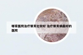 哪家醫(yī)院治療銀宵比較好 治療銀宵病最好的醫(yī)院