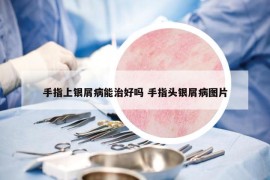 手指上銀屑病能治好嗎 手指頭銀屑病圖片