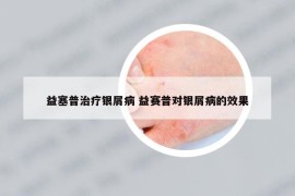益塞普治療銀屑病 益賽普對銀屑病的效果