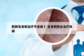 新鮮皂角刺治療牛皮癬麼 皂角刺熬水治療皮癬