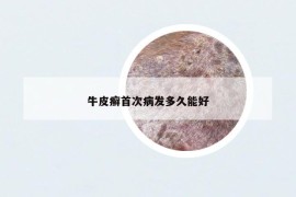 牛皮癬首次病發(fā)多久能好