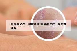 銀屑病光療一周做幾次 銀屑病光療一周做幾次好