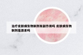 治療皮膚病生物制劑有副作用嗎 皮膚病生物制劑是激素嗎