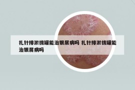 扎針排淤拔罐能治銀屑病嗎 扎針排淤拔罐能治銀屑病嗎