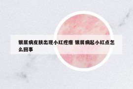 銀屑病皮膚出現小紅疙瘩 銀屑病起小紅點怎么回事