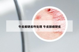 牛皮癬硬皮咋處理 牛皮膚癬硬皮