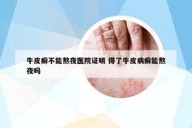 牛皮癬不能熬夜醫(yī)院證明 得了牛皮病癬能熬夜嗎
