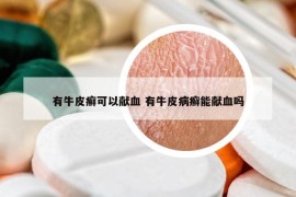 有牛皮癬可以獻(xiàn)血 有牛皮病癬能獻(xiàn)血嗎