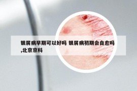 銀屑病早期可以好嗎 銀屑病初期會自愈嗎 ,北京京科