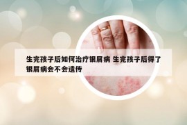 生完孩子后如何治療銀屑病 生完孩子后得了銀屑病會不會遺傳