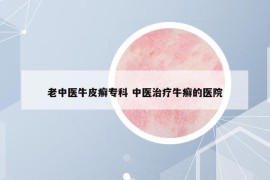老中醫(yī)牛皮癬?？?中醫(yī)治療牛癬的醫(yī)院