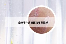 南京看牛皮癬醫(yī)院哪家最好