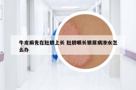 牛皮癬先在肚臍上長 肚臍眼長銀屑病滲水怎么辦