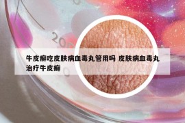牛皮癬吃皮膚病血毒丸管用嗎 皮膚病血毒丸治療牛皮癬
