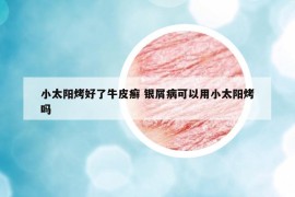 小太陽烤好了牛皮癬 銀屑病可以用小太陽烤嗎