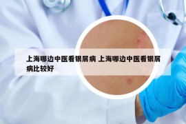 上海哪邊中醫(yī)看銀屑病 上海哪邊中醫(yī)看銀屑病比較好