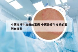 中醫(yī)治療牛皮癬的案例 中醫(yī)治療牛皮癬的案例有哪些