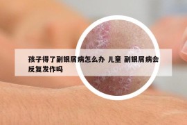 孩子得了副銀屑病怎么辦 兒童 副銀屑病會(huì)反復(fù)發(fā)作嗎