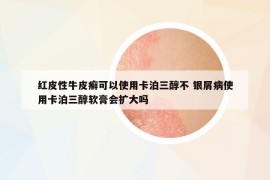 紅皮性牛皮癬可以使用卡泊三醇不 銀屑病使用卡泊三醇軟膏會擴大嗎